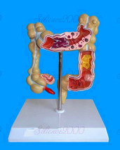 Human Colon Polyp Cancer Ulcer Diseased Organ  Anatomical Medical Teach ... - £26.86 GBP