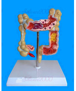 Human Colon Polyp Cancer Ulcer Diseased Organ  Anatomical Medical Teach ... - €29,52 EUR