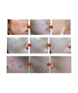 MEIKING Face Mask Skin Care Whitening Acne Treatment Remove Blackheads, ... - $47.47 CAD