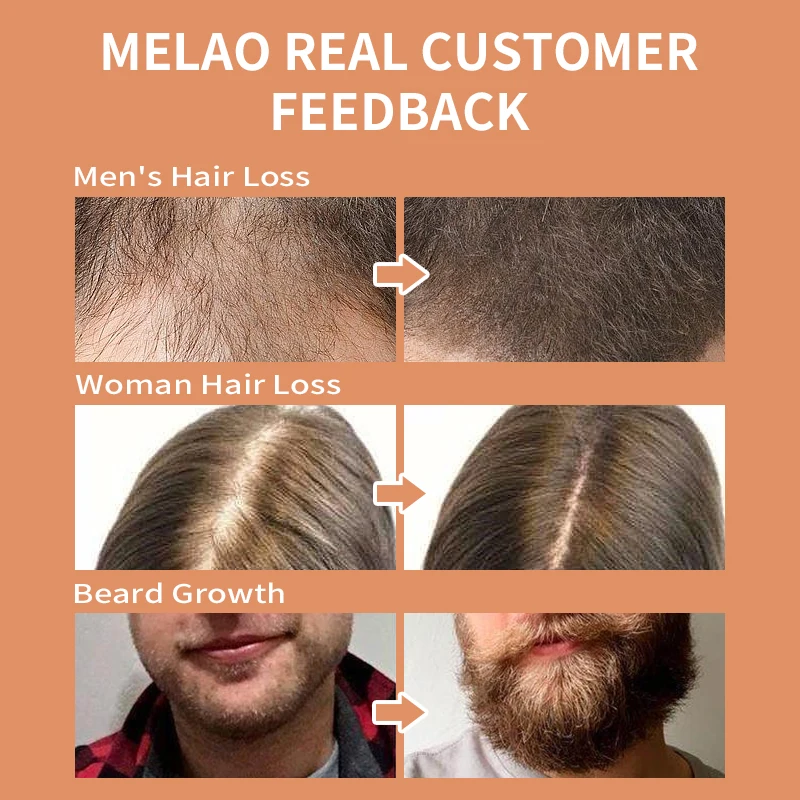 House Home Hair Growth Products MELAO 30ml Ginger Serum Fast Growing Hair Essent - £30.67 GBP