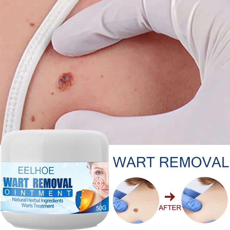 Sporting 1PC Wart Removal A Natura Herbal Extract Body Warts Treatment Foot Corn - £23.82 GBP