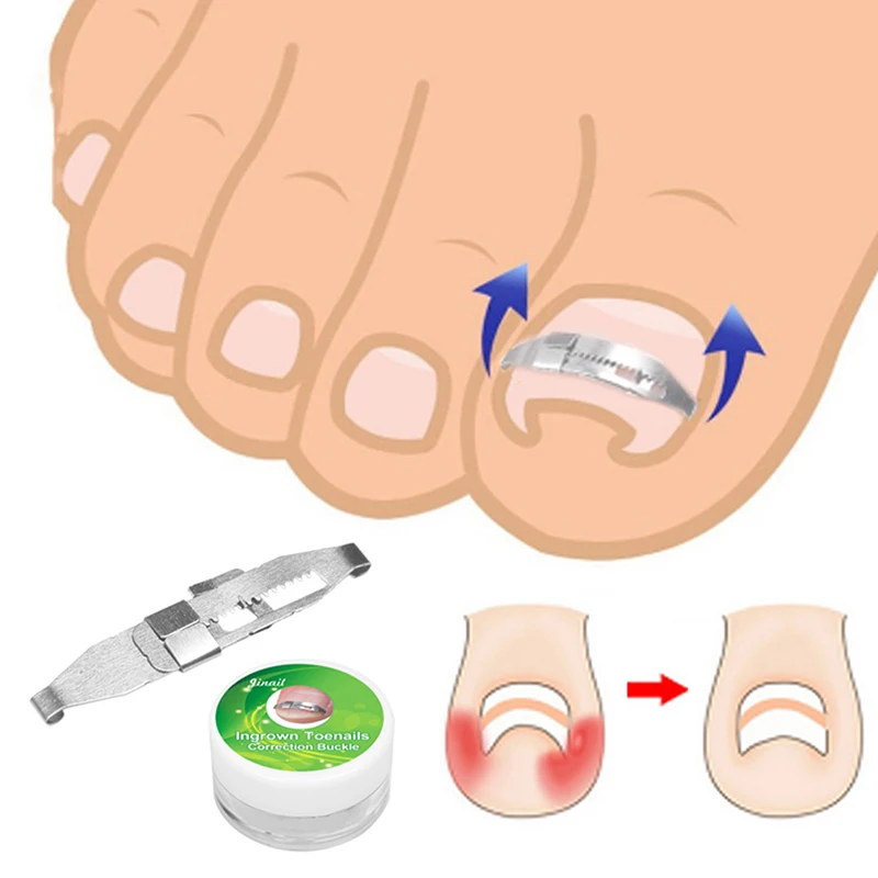 Ingrown Toenail Corrector Tool Pedicure Recover Embed Toe Nail Treatment - £12.61 GBP