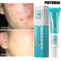 Salicylic Acid Acne Removal Cream – Pimple Spot Treatment, Oil Control. - $20.99