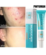 Salicylic Acid Acne Removal Cream – Pimple Spot Treatment, Oil Control. - €17,97 EUR