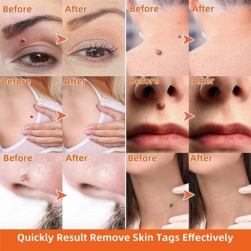 Game Fun Play Toys Skin Tag Remover Painless Mole Skin Dark Spot Wart Removal Se - £23.10 GBP
