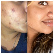 Acne Face Cream, Pimples, Dark Mark Treatment Cream - $17.38