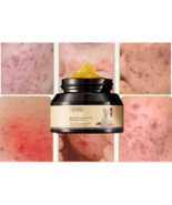 EFICAZ Crema para el acné ELIMINA Espinillas Espinillas Manchas hombres ... - $14.95