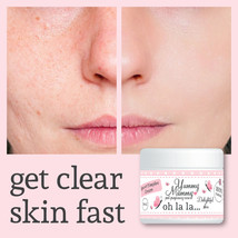 YUMMY MUMMY AFTER BIRTH SPOTS &amp; PIMPLES CREAM TREATMENT CLEAR COMPLEXION - £26.75 GBP