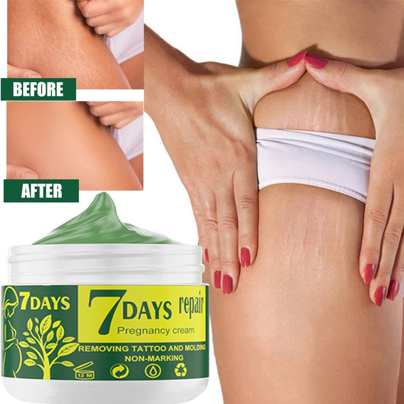 Ch marks removal a body ak repairing whitening pregnancy stretch scar mark remover skin thumb200
