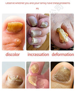 Anti-Fungal Liquid Nail Manicure - $54.63 CAD