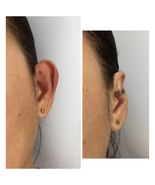 Protruding ear corrector EARCLIC - £39.33 GBP