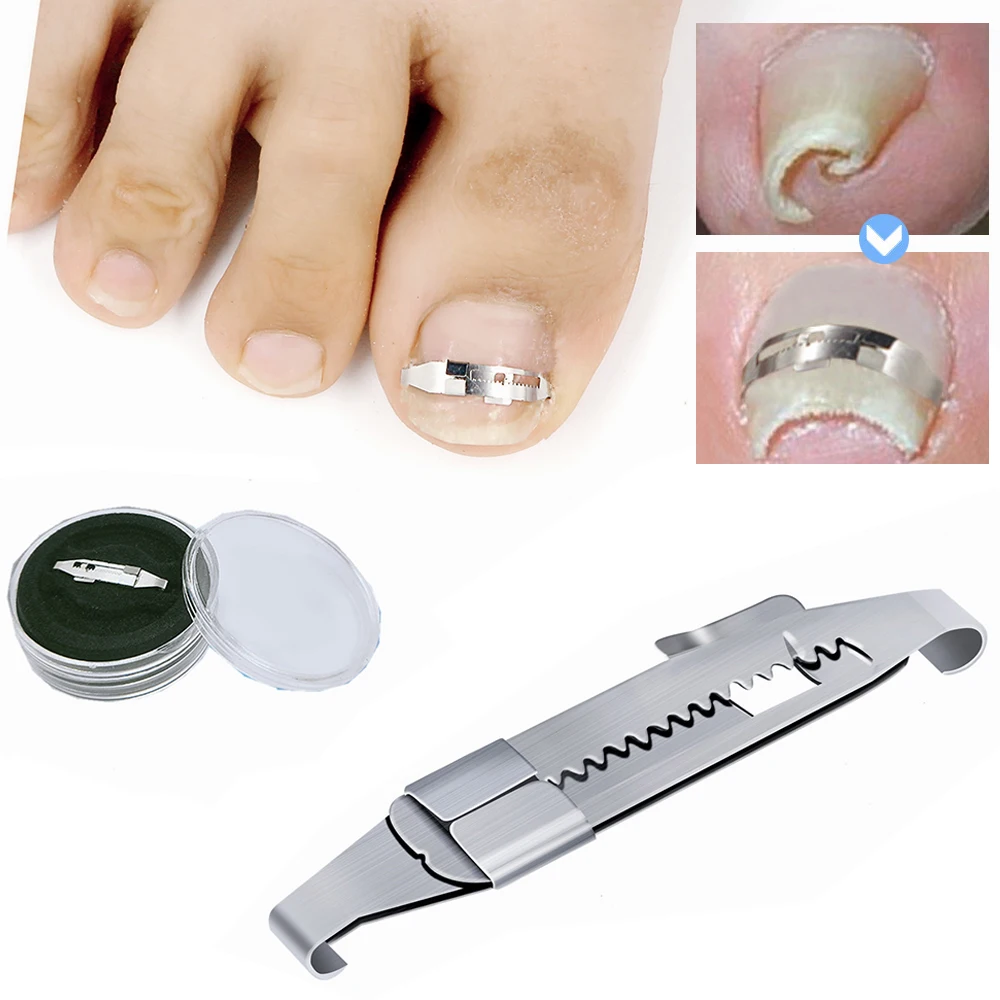 Professional Ingrown Toenail Corrector Recover Embed Toe Nail Treatment Ingrown - £9.19 GBP