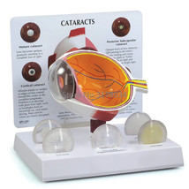 Human Cataract Eye Anatomical Model Body Anatomy Replica Normal Eye Doct... - £41.03 GBP