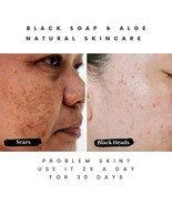 The Buyer’s Guide to Acne Soap Features - $13.62 CAD