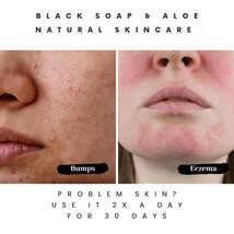 Pimple-Free Skin: Black Soap&#39;s Purity Secret - $11.28