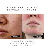 Pimple-Free Skin: Black Soap&#39;s Purity Secret - $9.89