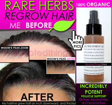 BEST ORGANIC Hair Loss Treatment and Hair Growth Support Anti Dandruff Spray - $44.99