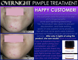 Best Overnight Pimple Treatment For Zits, Boils, And Cysts Fast Remedy  - £19.28 GBP