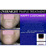 BEST OVERNIGHT Pimple Treatment for ZITS, BOILS, and CYSTS FAST REMEDY  - £18.79 GBP