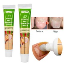 Nail Fungal Treatment Ointment Anti Infection Paronychia Onychomycosis F... - $16.13