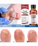 Fungal Nail Treatment Serum Fungus Removal  Paronychia Foot Repair Care ... - $20.00+