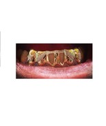 14k gold Overlay Removable gold teeth caps Grillz &amp; mold kit 6 teeth gri... - £82.13 GBP