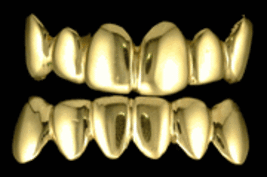 14k gold Overlay Removable gold teeth caps Grillz 12 teeth top bottom - £164.27 GBP