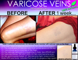 Natural Varicose Vein Treatment And Spider Vein Treatment 2 In 1 Stimulating Oil - £46.92 GBP