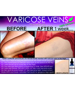 NATURAL VARICOSE VEIN TREATMENT AND SPIDER VEIN TREATMENT 2 IN 1 STIMULATING OIL - $59.99