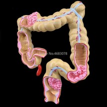 Colorectal Lesion Model Human Colon Intestine Pathological Diseases Anatomy - £35.64 GBP