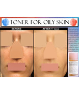 ALCOHOL FREE HERBAL Toner For Oily Skin &amp; Acne with Salicylic Acid and L... - £25.49 GBP