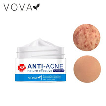 VOVA Anti-Acne Nature Effective Pure Skin Cream - Stop Breakouts Scarring - £7.98 GBP