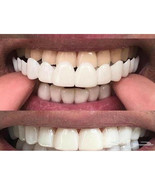 Snap On False Teeth Upper + Lower Dental Veneers Dentures Tooth Cover Se... - £11.09 GBP