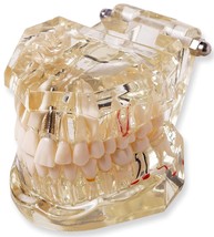 Transparent Dental Model To Demonstrate Dental Implant Dental Diseases Cavities - £39.56 GBP