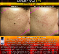 BEST Treatment for Indented Scars Acne Chicken Pox Pitted Scar Removal Peel  - £40.10 GBP