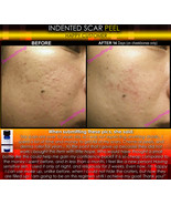 BEST Treatment for Indented Scars Acne Chicken Pox Pitted Scar Removal P... - £39.95 GBP