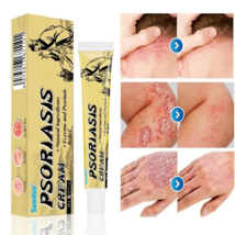 Crema Para Dermatitis Eczema Psoriasis Para Comezon Picazon Ronchas En La Piel - £14.87 GBP