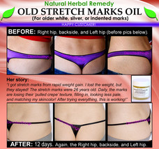 Natural Stretch Mark Remover Oil Herbal Remedy for Older White Silver Indented - £70.81 GBP