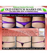 Natural Stretch Mark Remover Oil Herbal Remedy for Older White Silver In... - £71.72 GBP