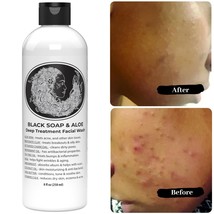 Acne Soap Ingredients That Work Wonders - $11.28