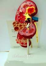 Human Anatomical Anatomy Kidney Diseased Pathological Stone Organ Medica... - $31.00