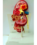 Human Anatomical Anatomy Kidney Diseased Pathological Stone Organ Medica... - €26,60 EUR