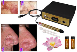 New Avance laser spider varicose vein reduction Machine, Fast Permanent Results - £799.16 GBP