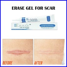 Erase Gel for Scar Remover Wound Care Keloid Acne Surgery Scars Remover ... - $29.99