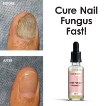 Nail Bright Serum – Antifungal Infection Stop Nail Fungus Stop Athletes Foot - £20.93 GBP