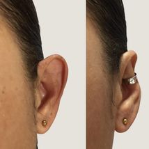 Protruding ear corrector EARCLIC - £39.62 GBP