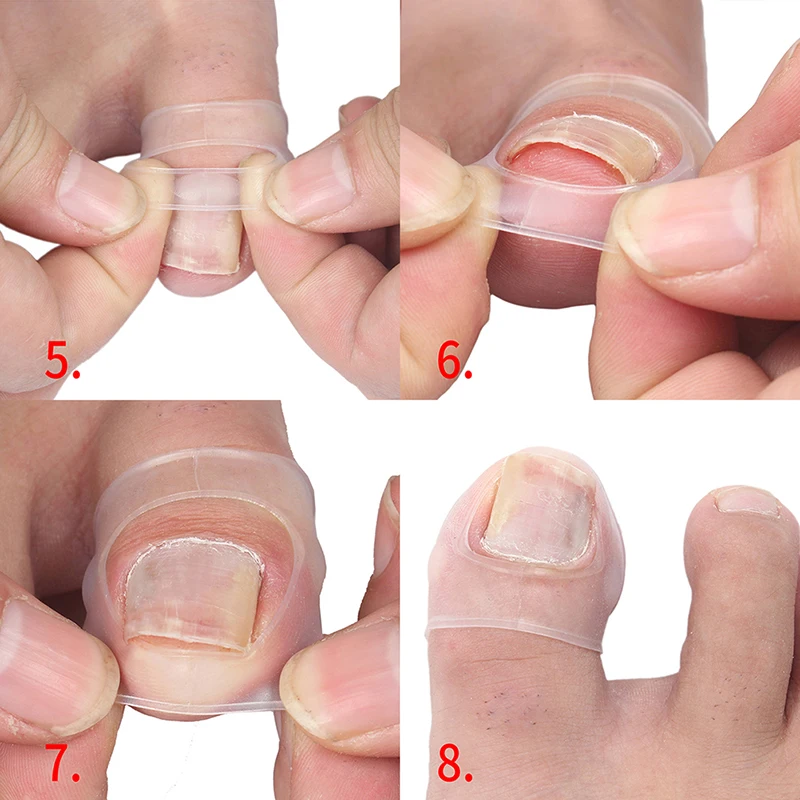 Ion tool invisible ingrown toe nail treatment elastic straightening clip brace pedicure thumb200