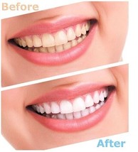 Advanced Teeth Whitening Strips (8 Strips) 4 Upper and 4 Lower~Hydrogen Peroxide - £7.77 GBP
