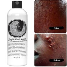 Black Soap for Acne: Banish Blemishes Naturally - £8.88 GBP
