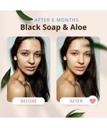 Face Off with Acne: Acne Killer Liquid Black Soap Edition - $13.62 CAD